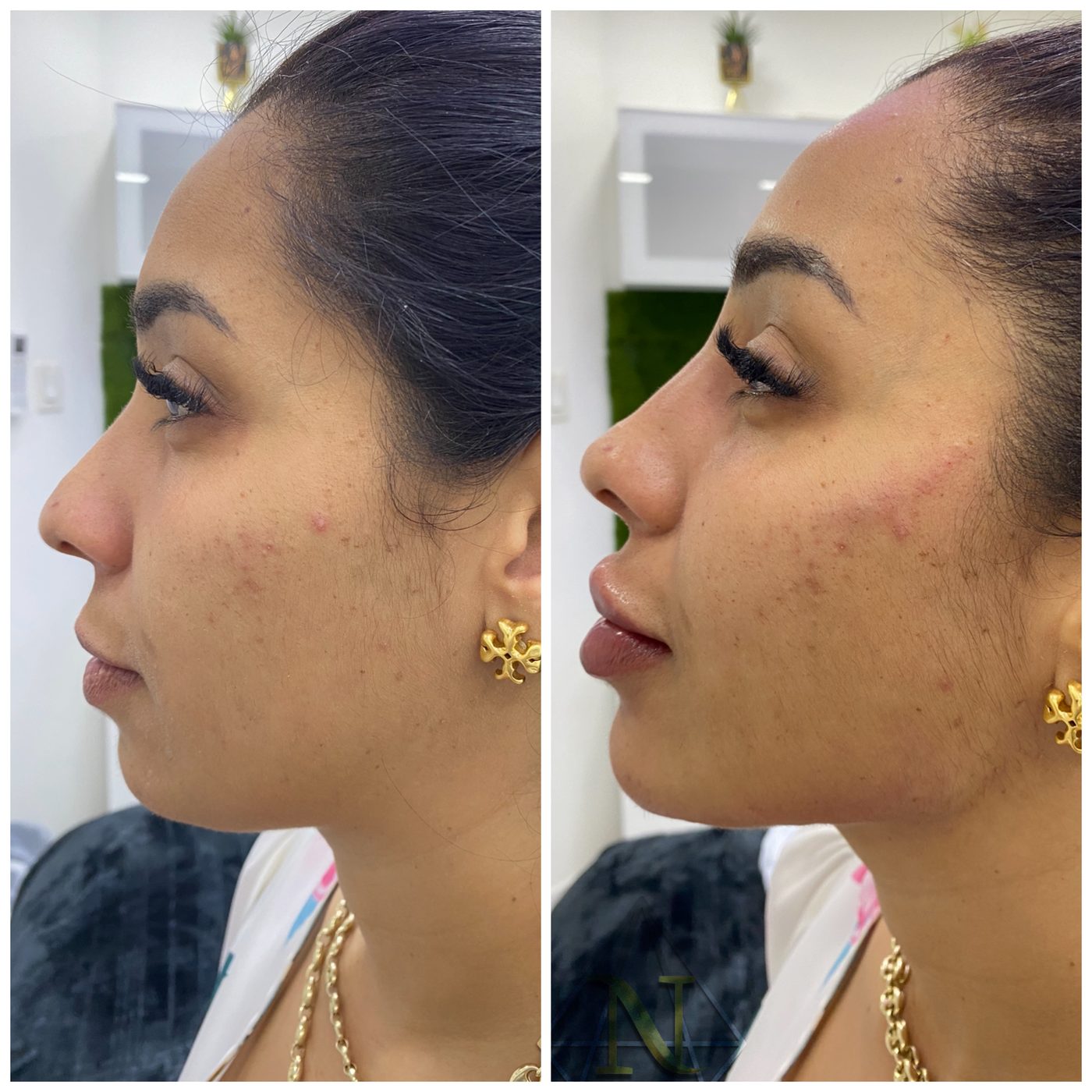 Resultado antes y despu&eacute;s — Rostro & Piel