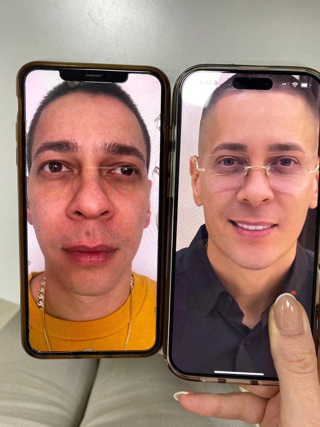 Resultado antes y despu&eacute;s — Rostro & Piel