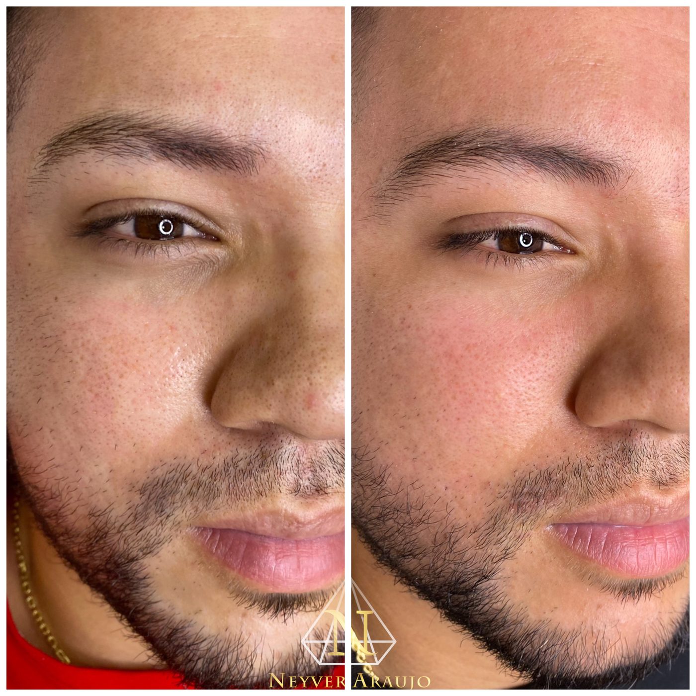Resultado antes y despu&eacute;s — Rostro & Piel