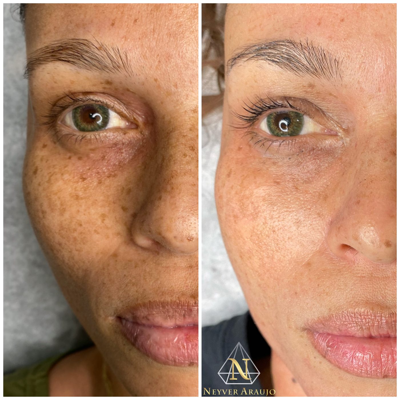 Resultado antes y despu&eacute;s — Rostro & Piel
