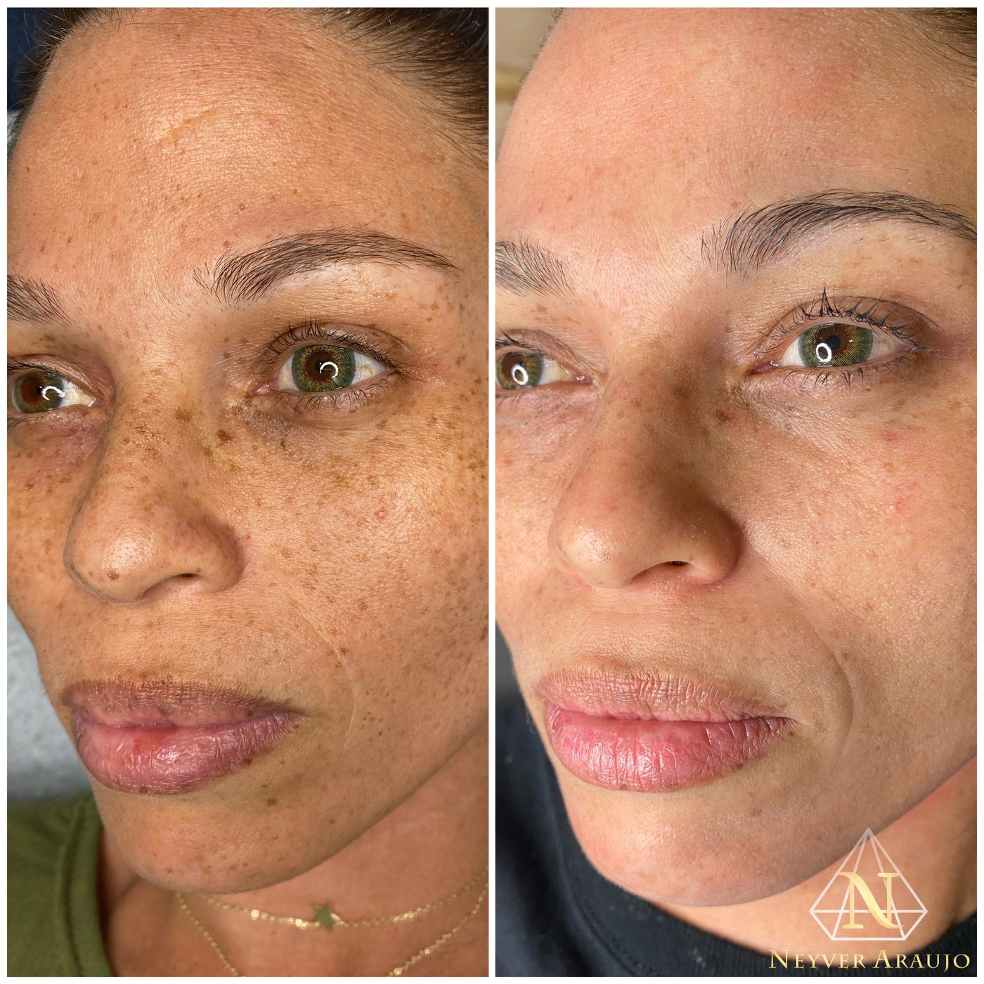 Resultado antes y despu&eacute;s — Rostro & Piel