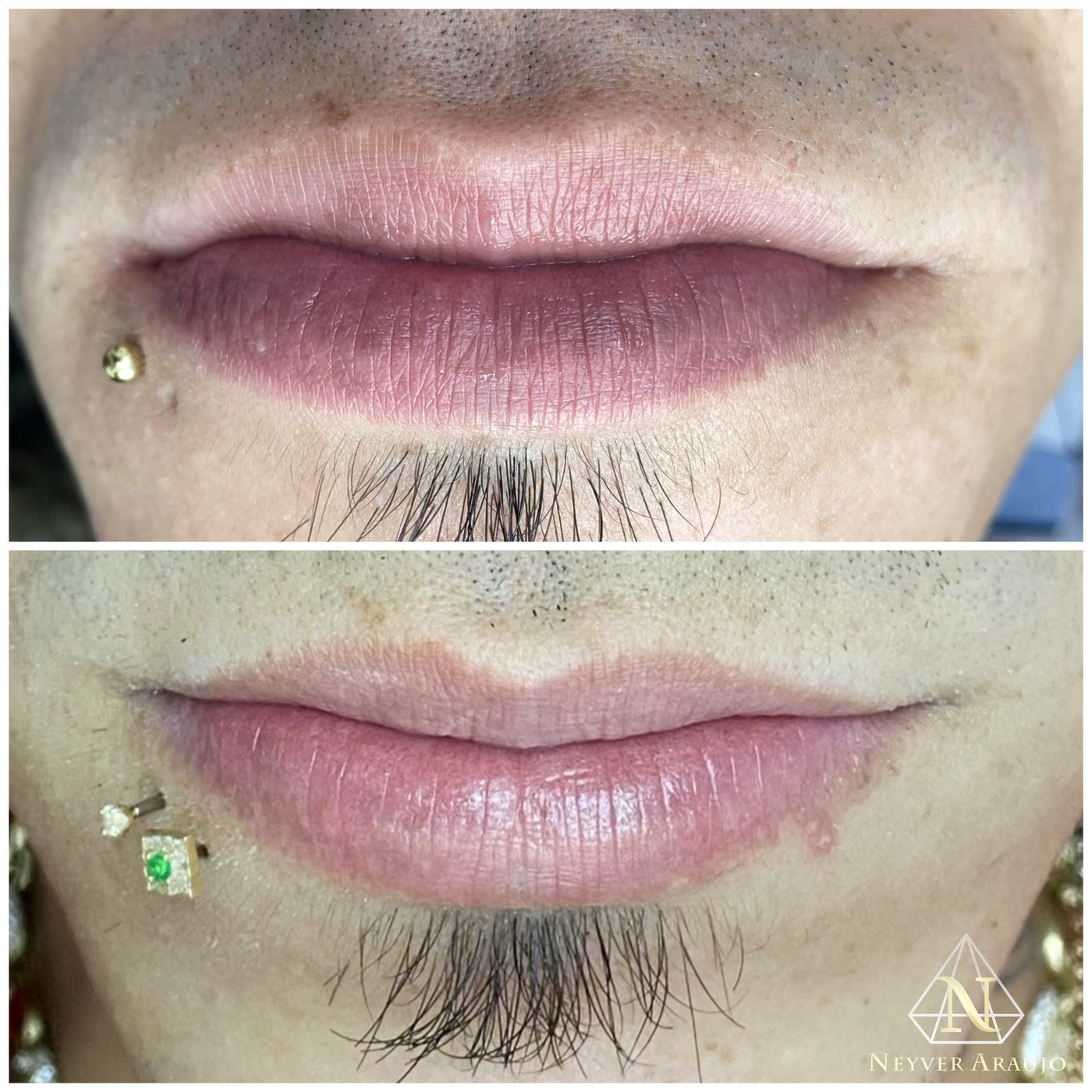 Resultado antes y despu&eacute;s — Labios