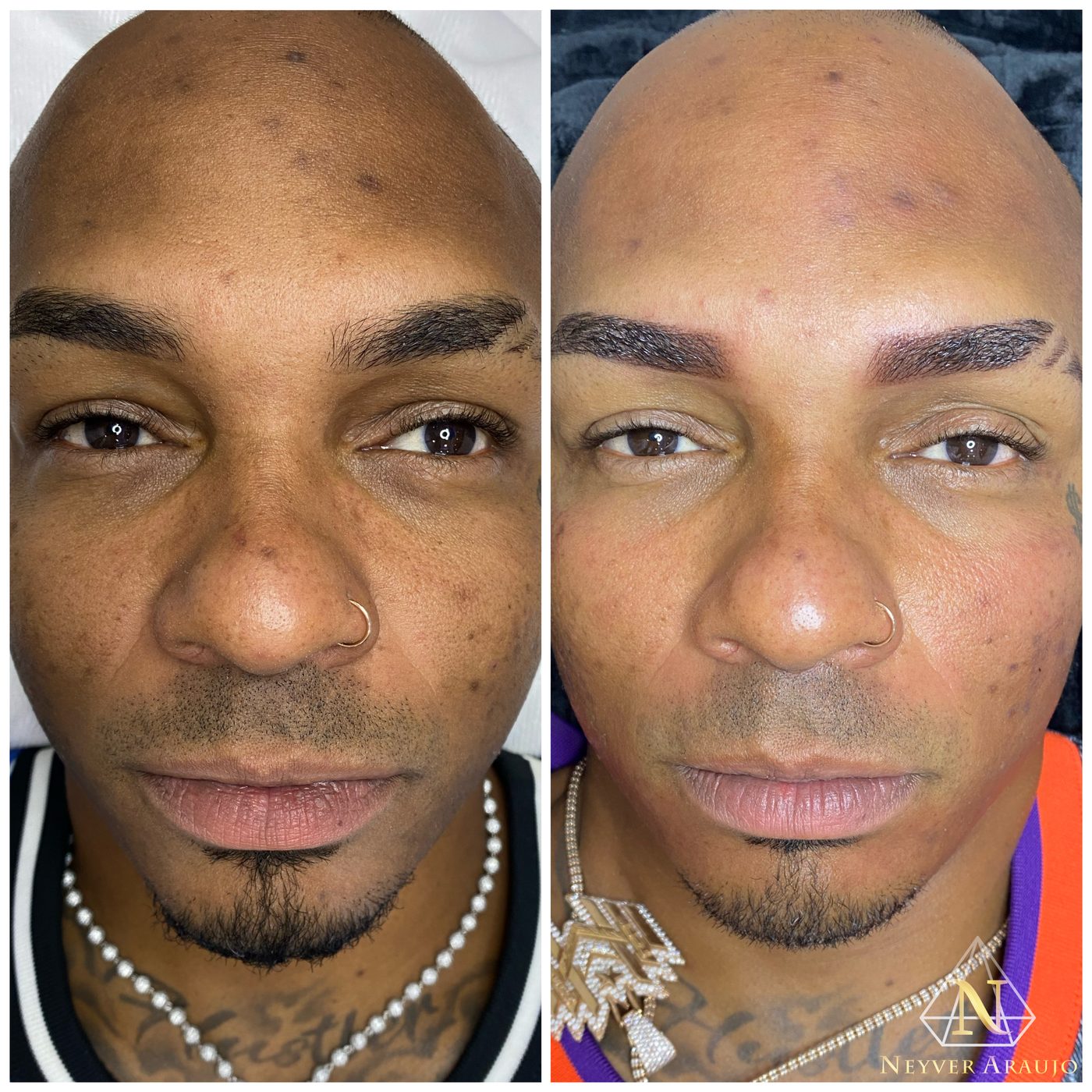 Resultado antes y despu&eacute;s — Rostro & Piel