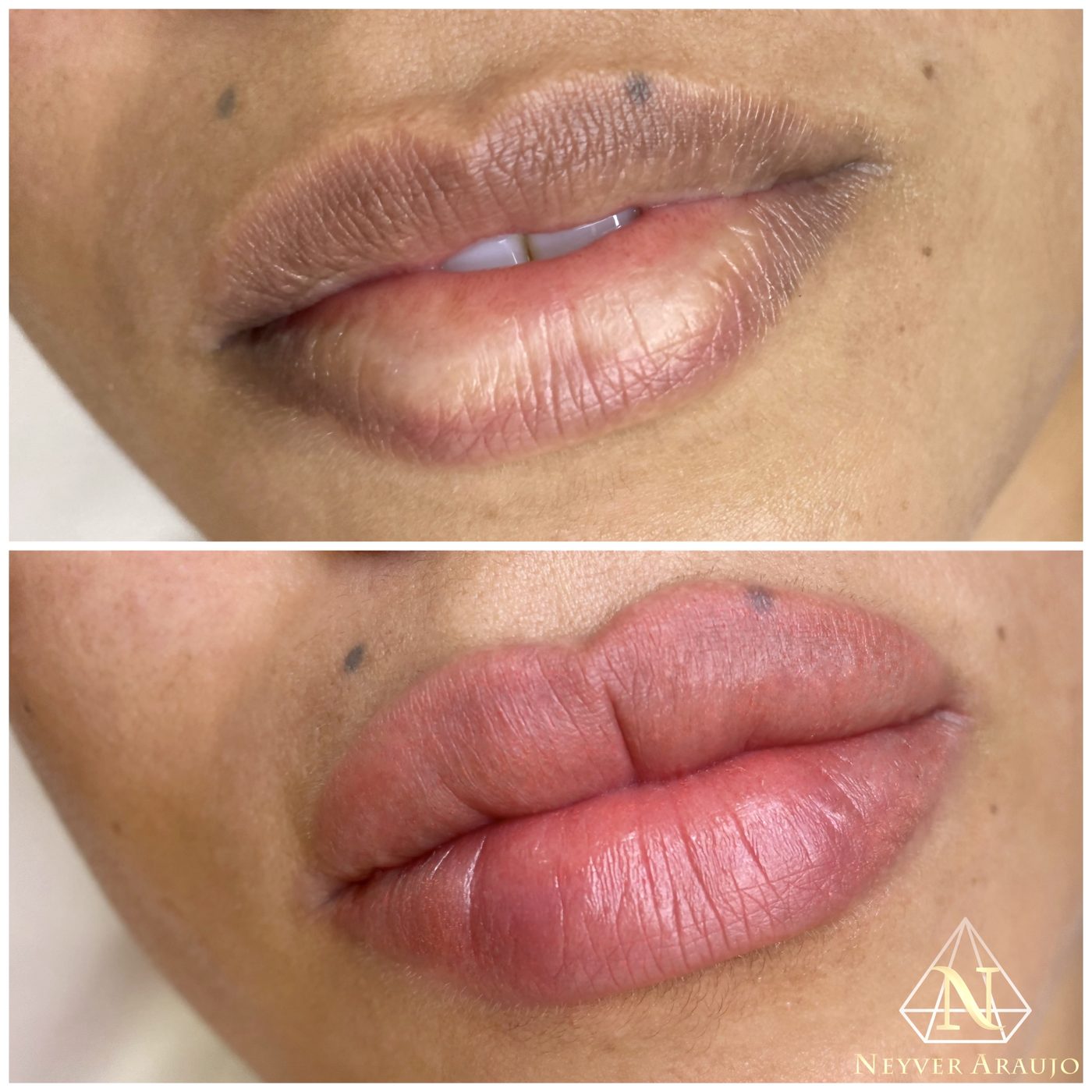 Resultado antes y despu&eacute;s — Labios