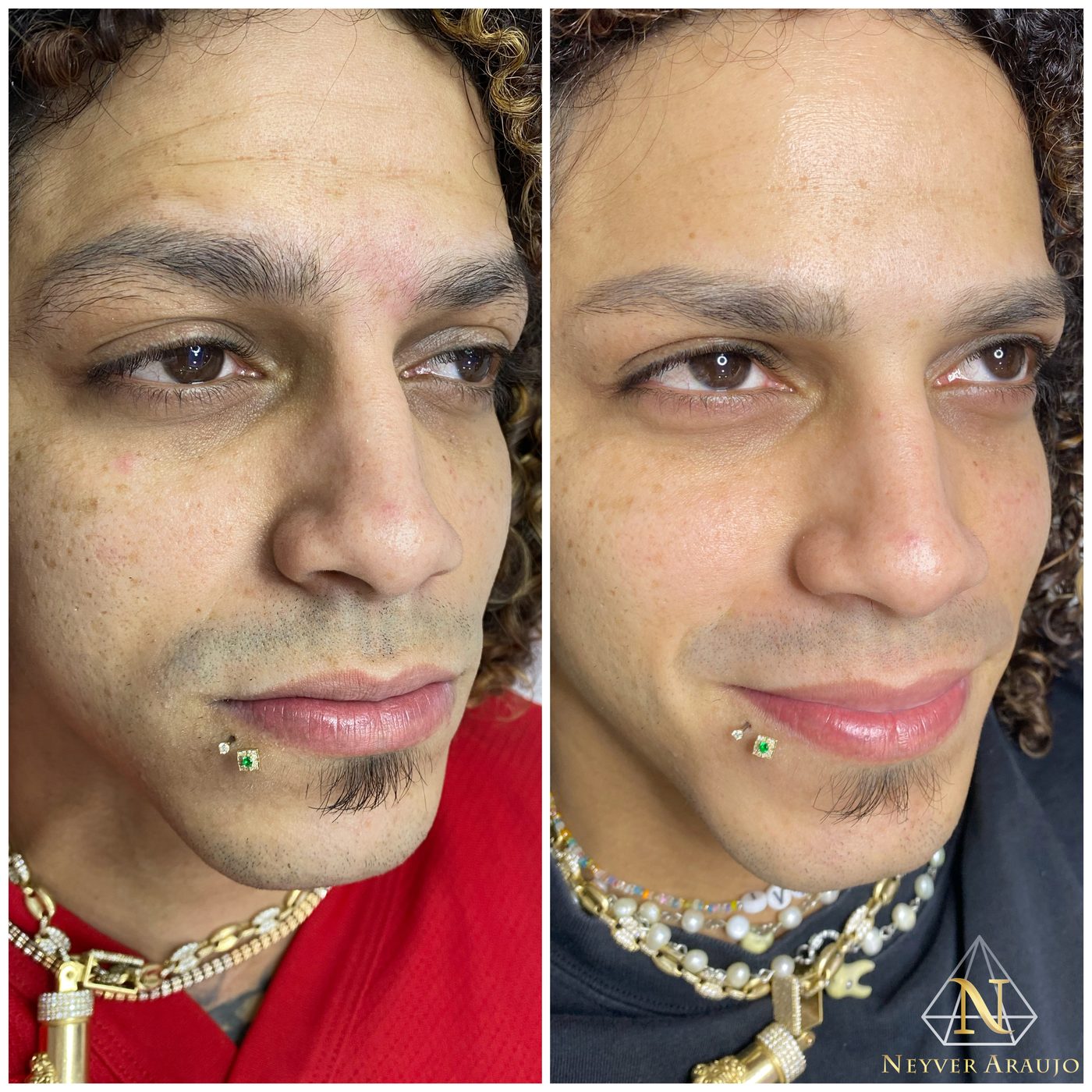Resultado antes y despu&eacute;s — Rostro & Piel