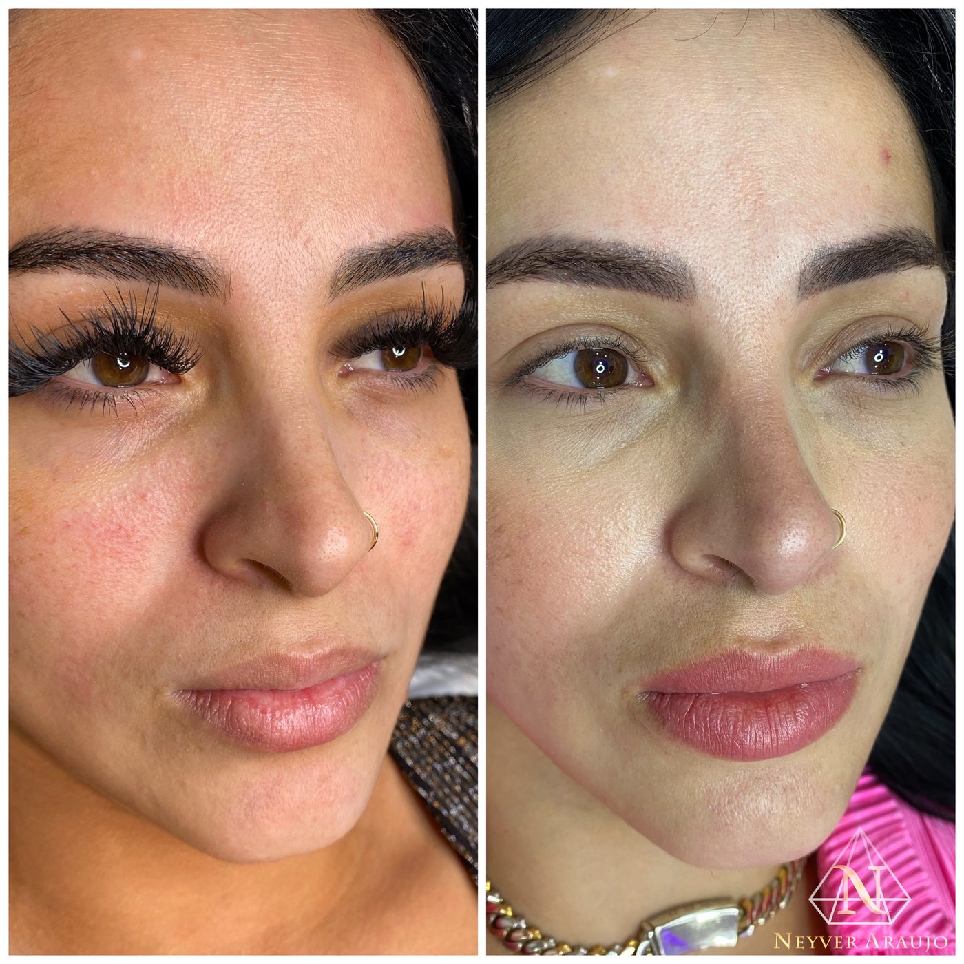 Resultado antes y despu&eacute;s — Rostro & Piel