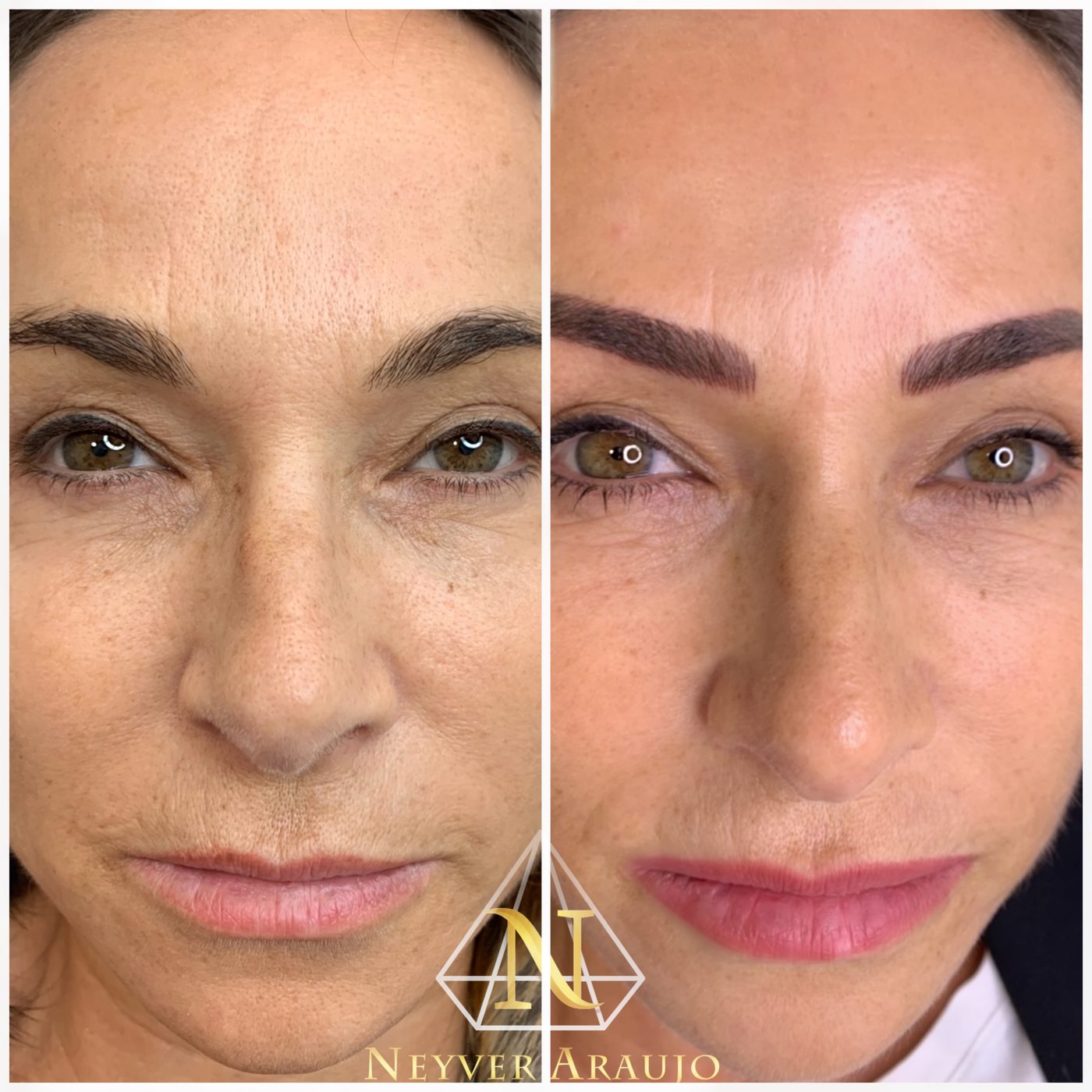 Resultado antes y despu&eacute;s — Rostro & Piel