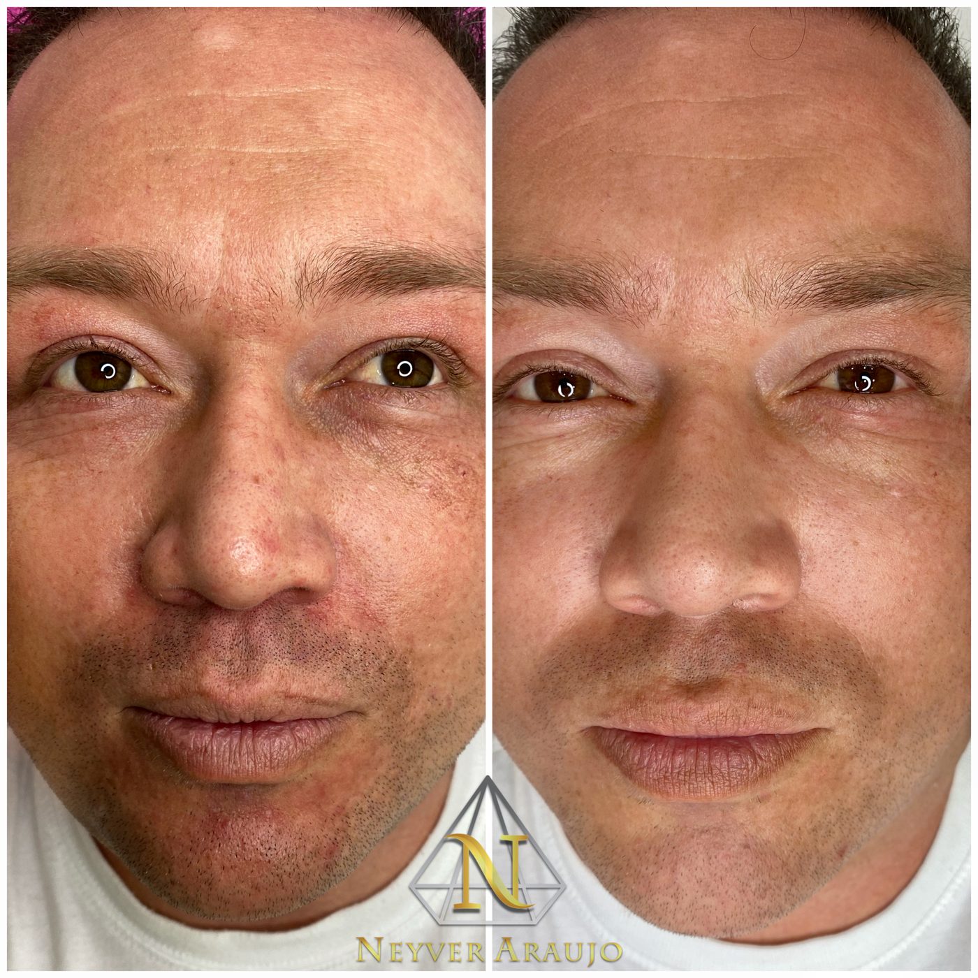 Resultado antes y despu&eacute;s — Rostro & Piel