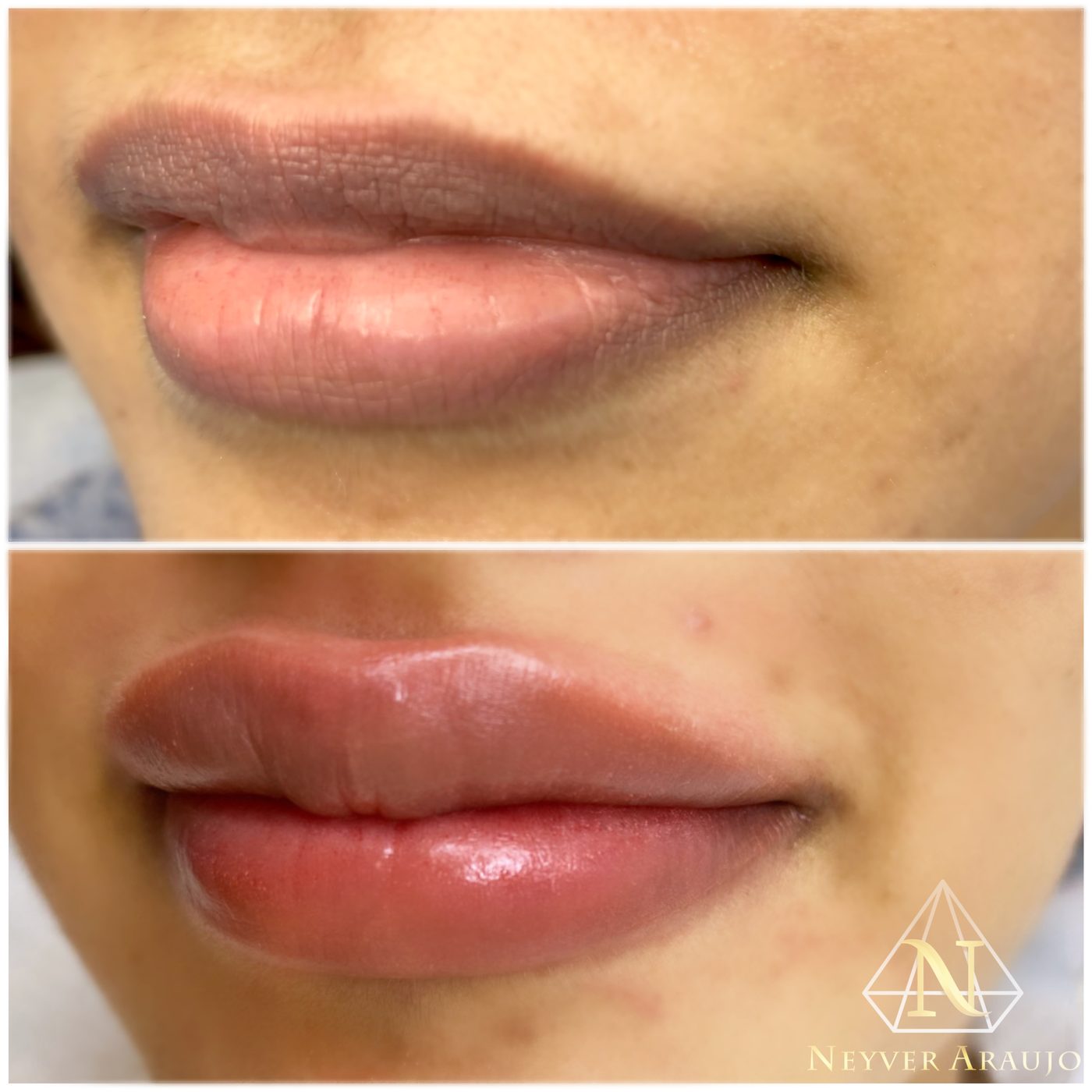 Resultado antes y despu&eacute;s — Labios
