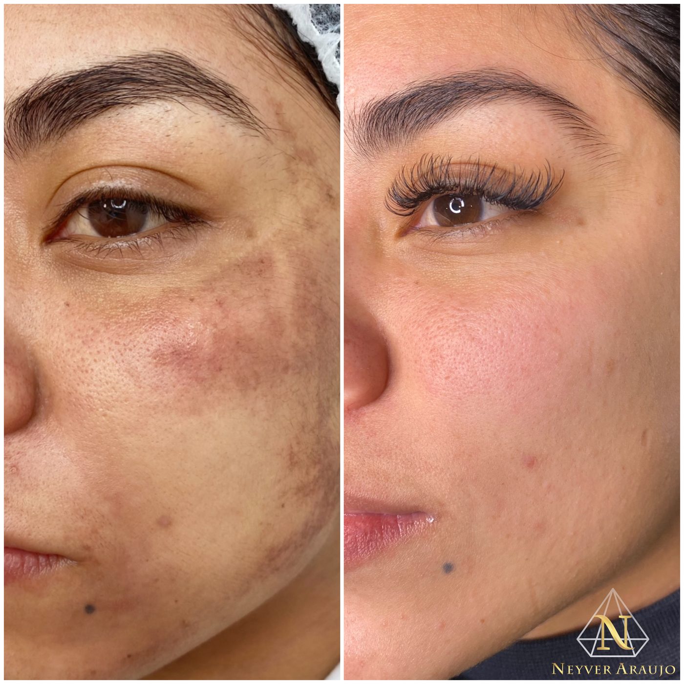 Resultado antes y despu&eacute;s — Rostro & Piel