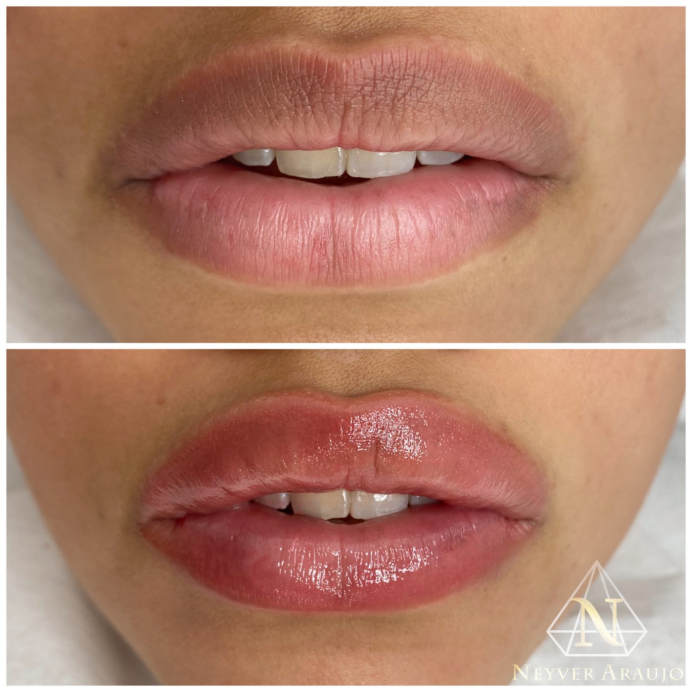 Resultado antes y despu&eacute;s — Labios