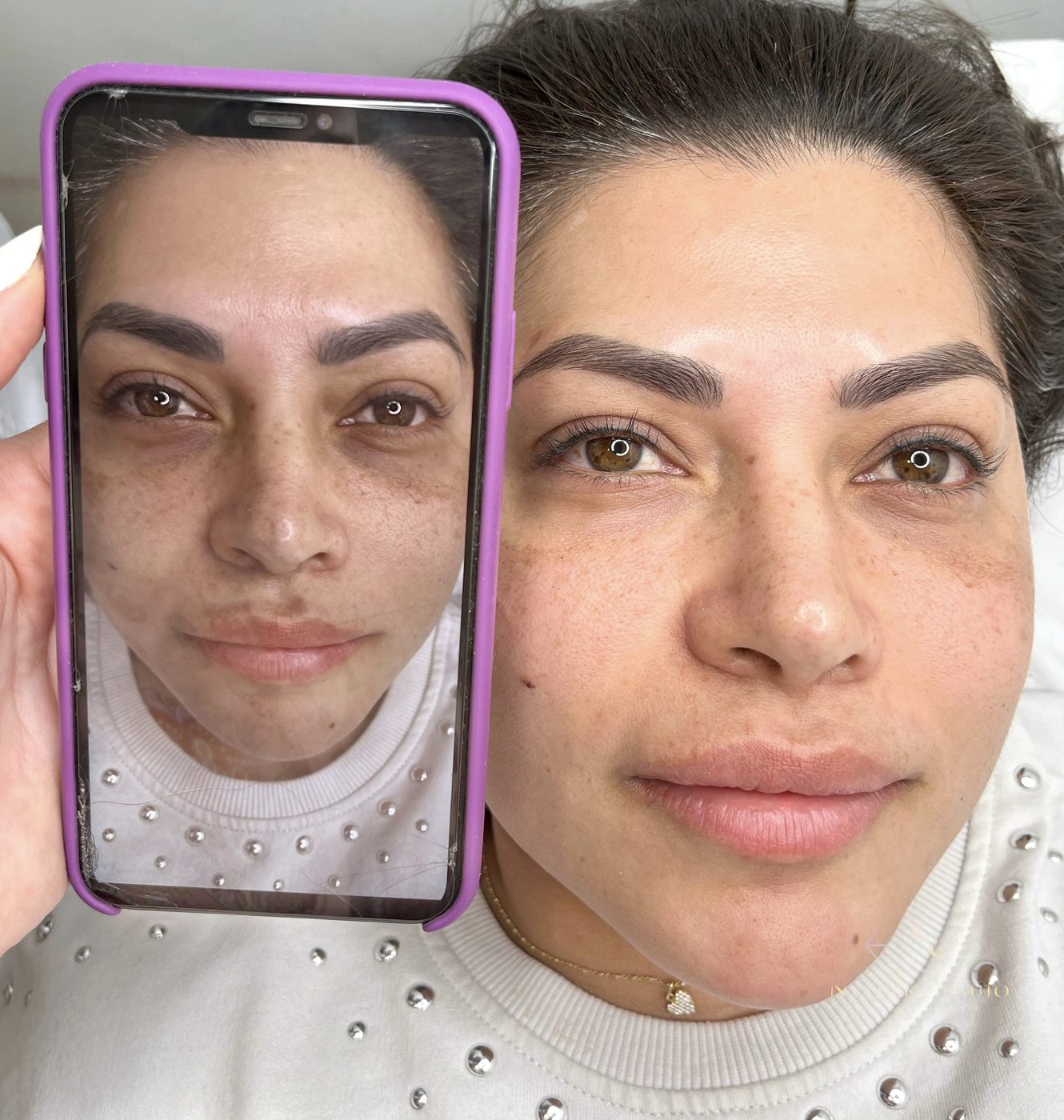Resultado antes y despu&eacute;s — Rostro & Piel