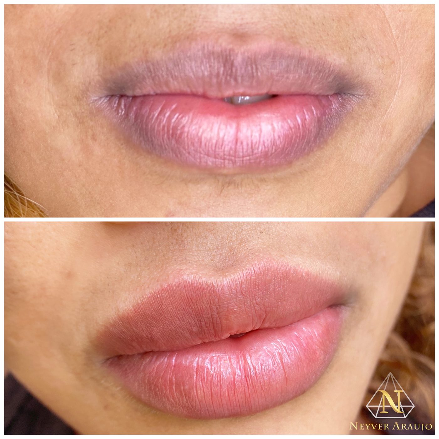 Resultado antes y despu&eacute;s — Labios