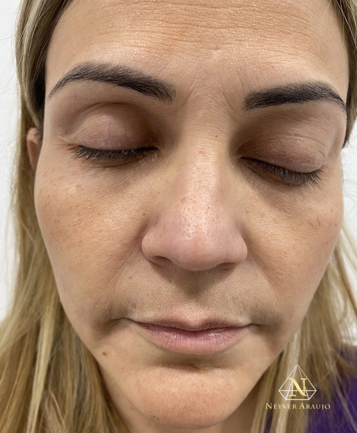 Resultado antes y despu&eacute;s — Rostro & Piel